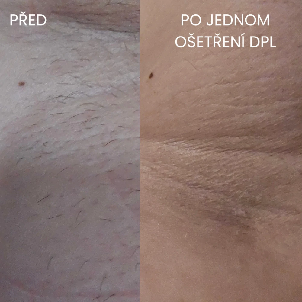 Přenosné DPL 